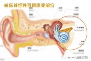 神经性耳聋&传导性耳聋，傻傻分不清？广州耳科哪家好-广东六一